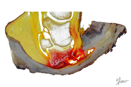 Coffin bone destruction in laminitis pathology specimen